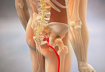 Sciatica treatment