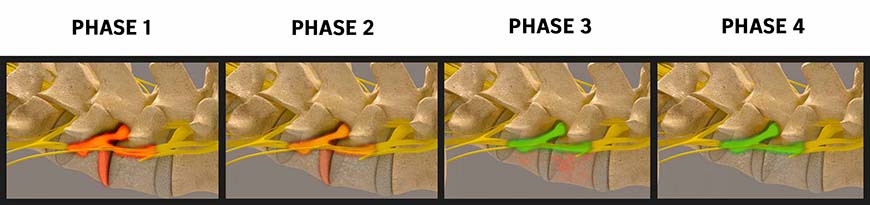 Phases of Spinal Decompression