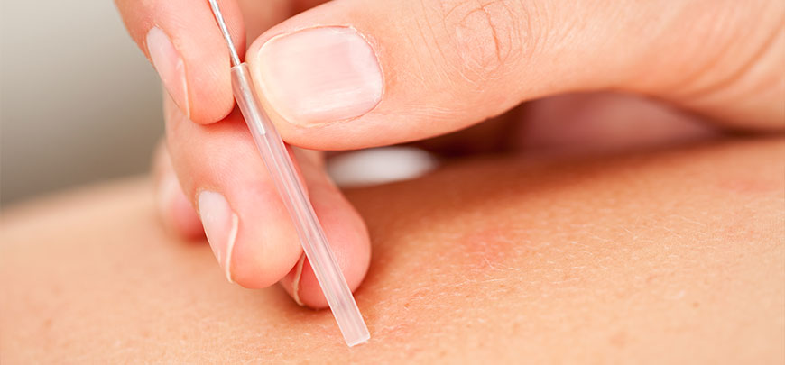 Patient performing Dry Needling after an auto accident